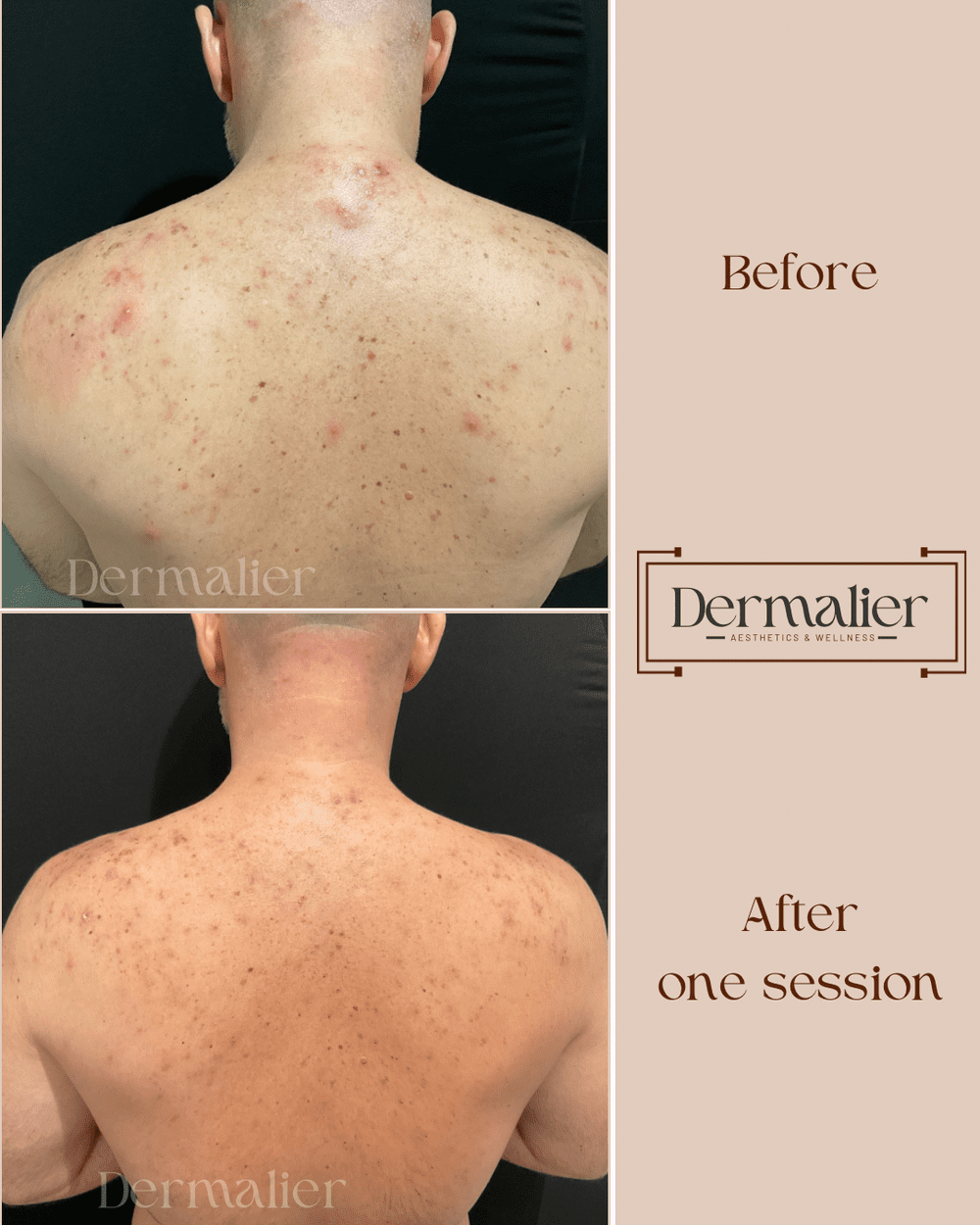 Dermalier patient before and after skin treatment