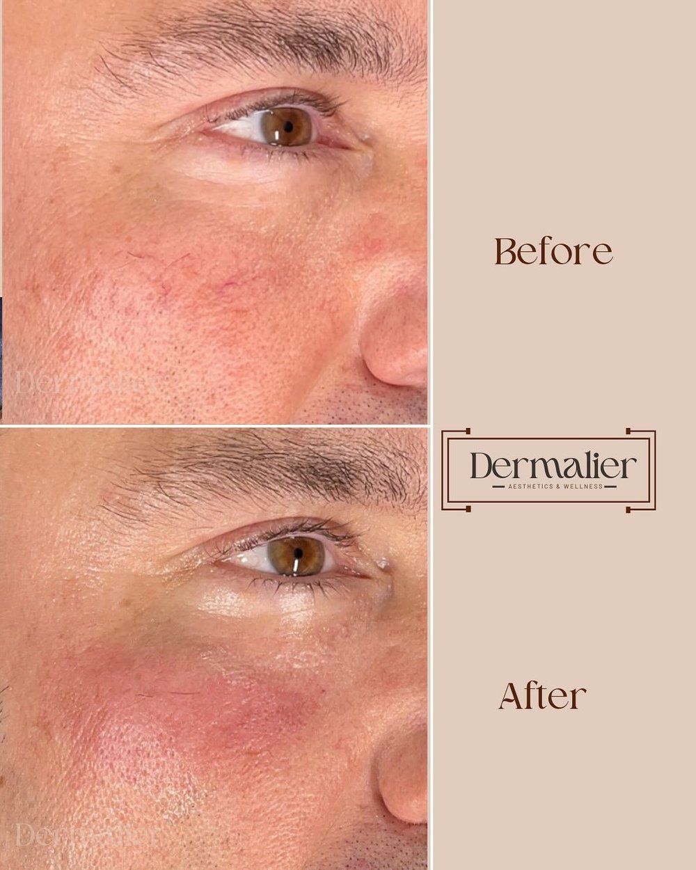 Dermalier patient before and after IPL treatment for facial capillaries