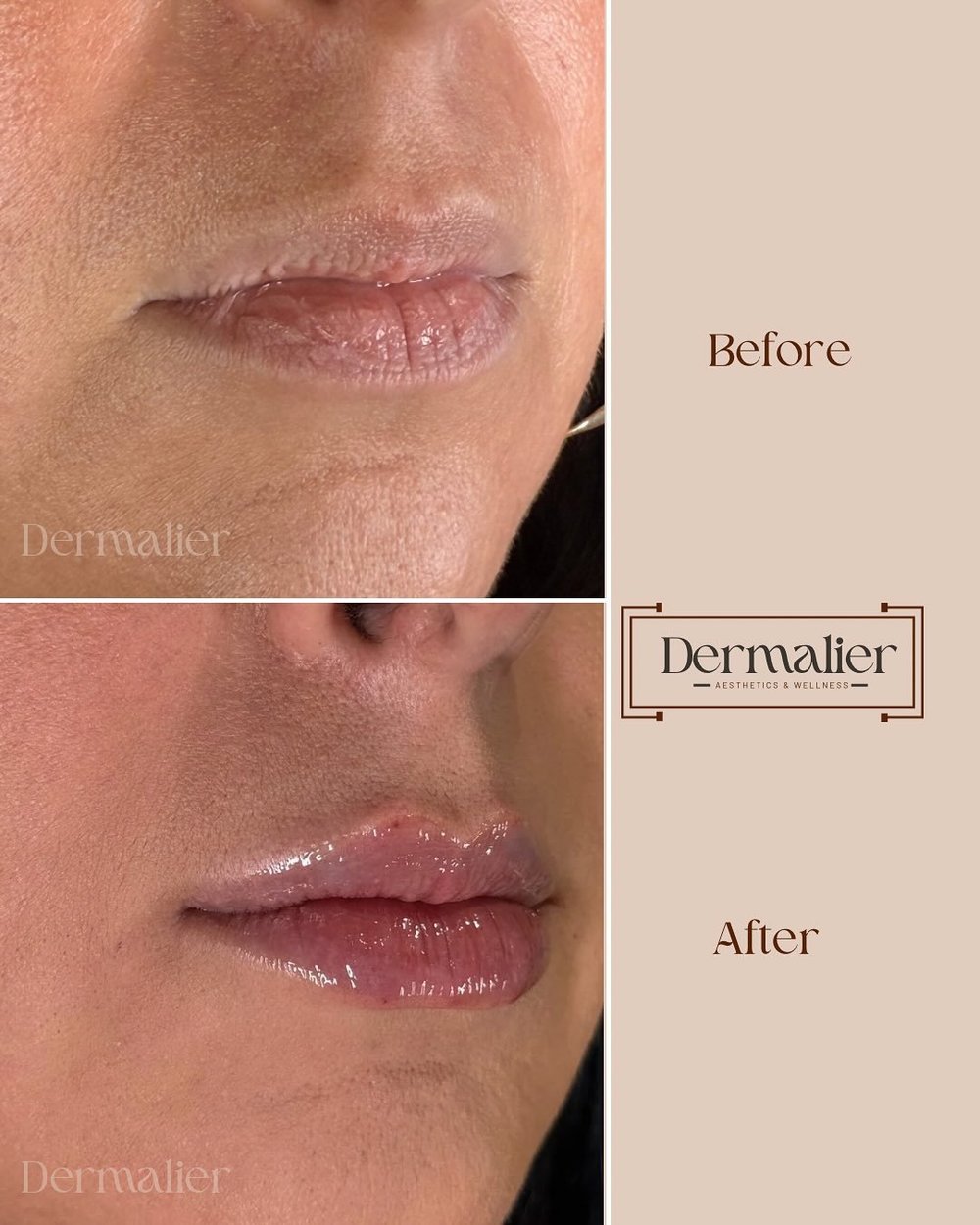 Natural lip filler before and after by Dermalier Clinic