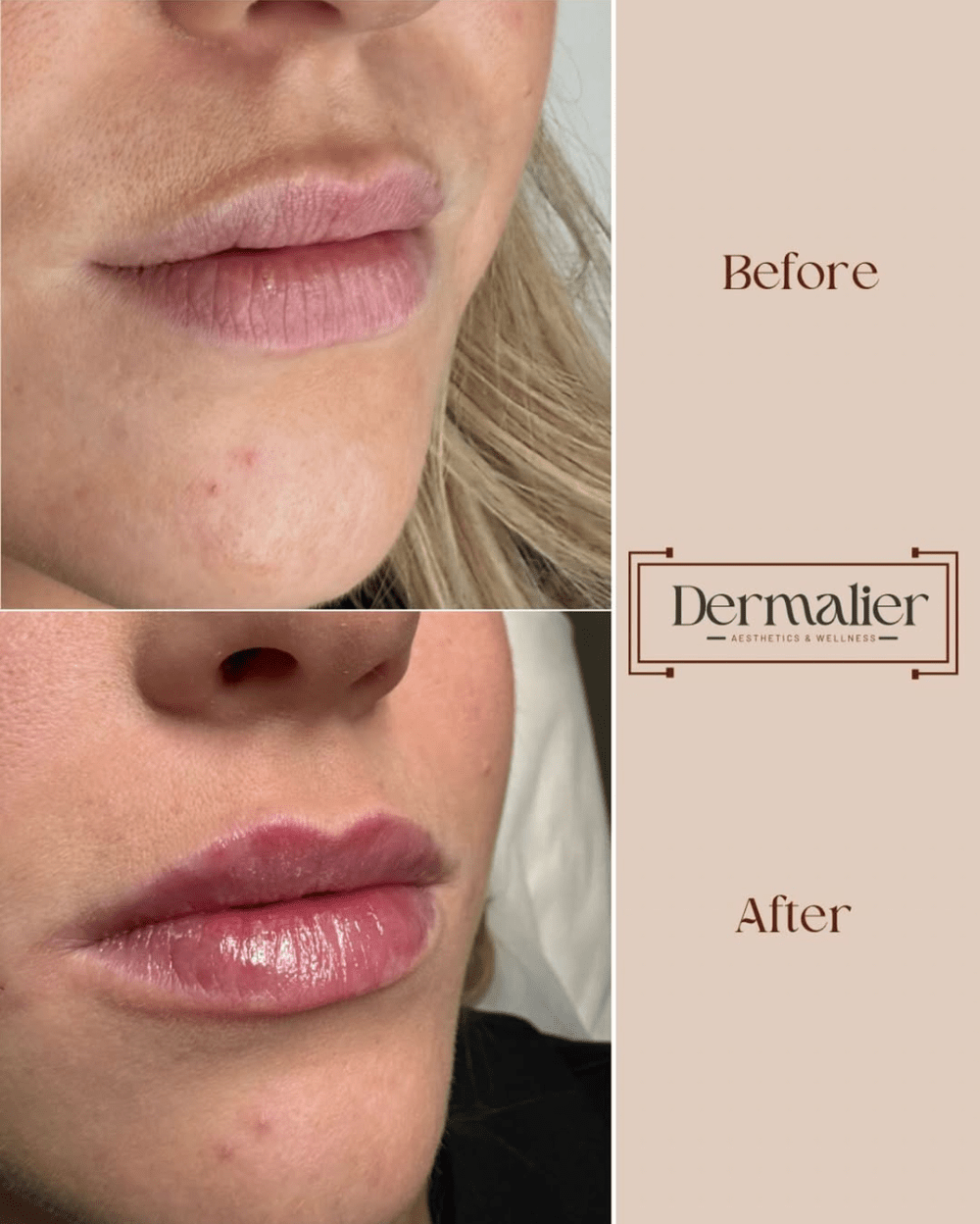Dermalier patient before and after lip filler